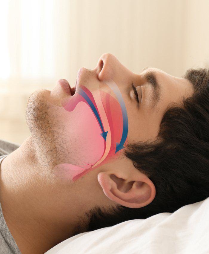 Comparison of normal airway vs. obstructive sleep apnea