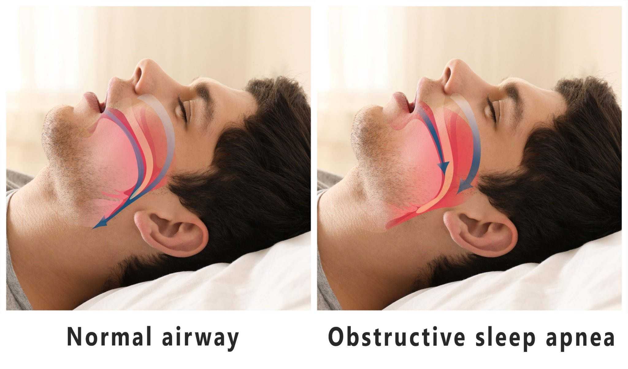 how-to-improve-obstructive-sleep-apnea-symptoms