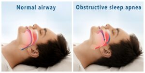 Comparison of normal and obstructive sleep apnea airway